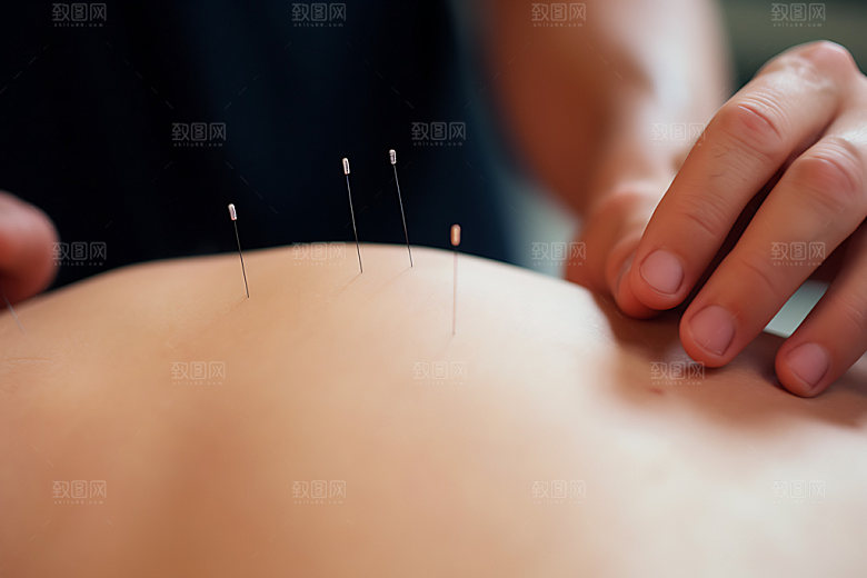 中医针灸医疗点穴摄影图
