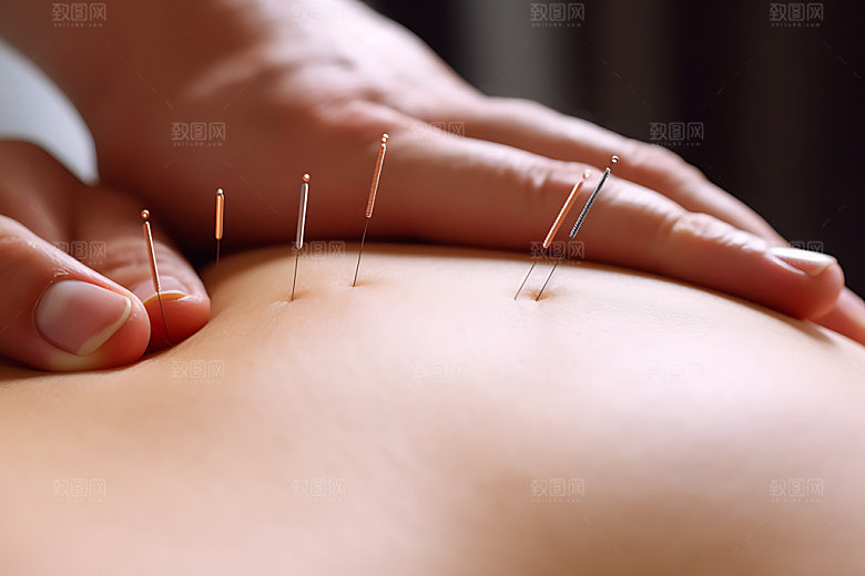 中医针灸治疗医疗摄影图