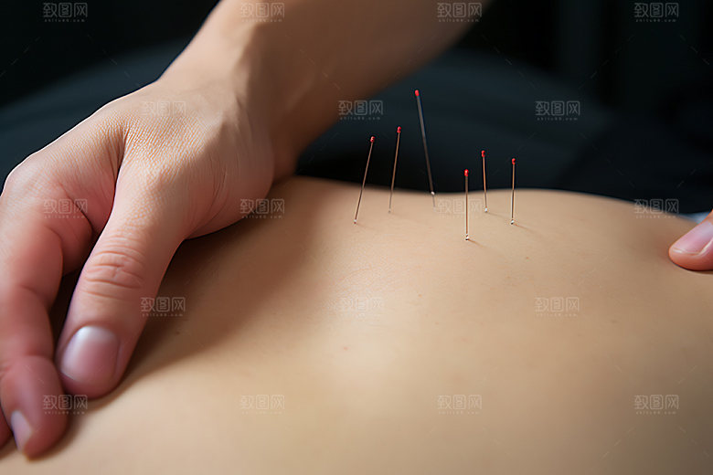中医针灸点穴治疗摄影图
